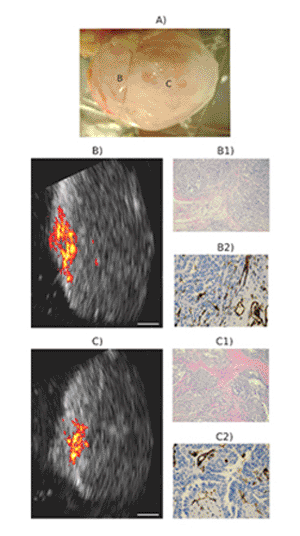 Image: A malignant postmenopausal ovary (A). Coregistered ultrasound and photoacoustic images of two different locations are shown in B and C. (B1 and C1) H&E stains (A-40) of the corresponding areas showing extensive high-grade tumors. (B2 and C2) CD31 stains (A-100) of the corresponding areas showing extensive thin-walled microvessels. White bar, 5 mm (Photo courtesy of the University of Connecticut School of Engineering).